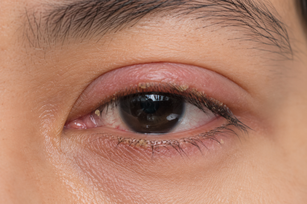 Blepharitis
